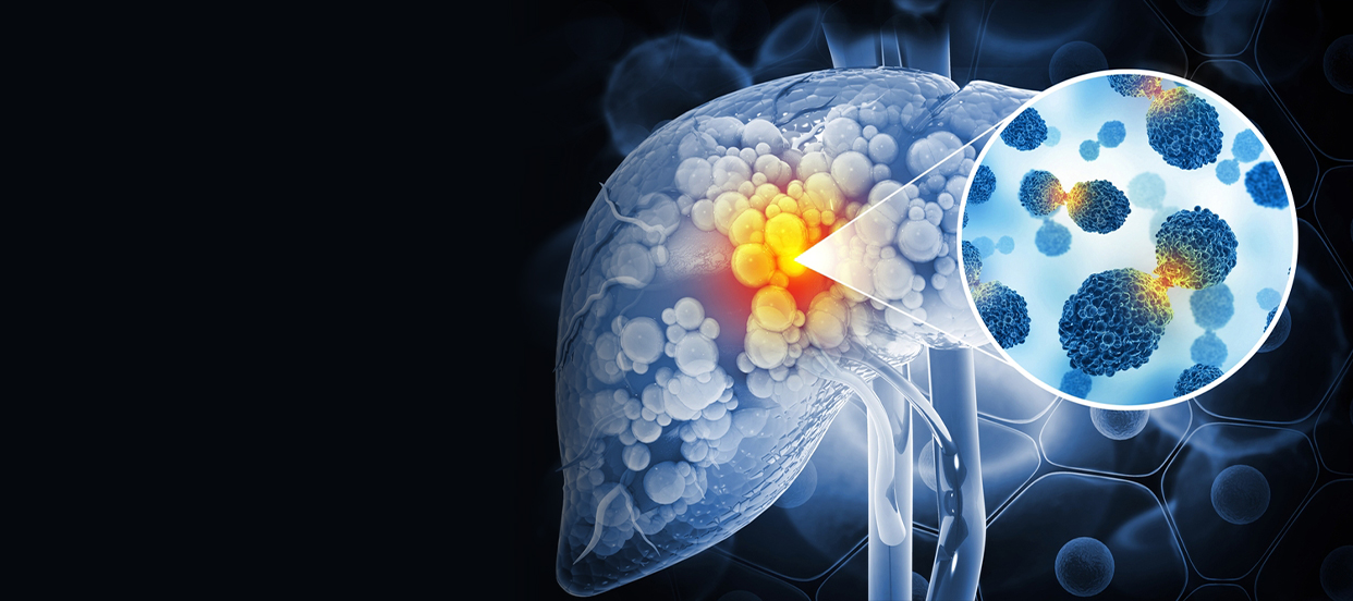 Liver Cancer Treatment in Lucknow: Best Options for Effective Care